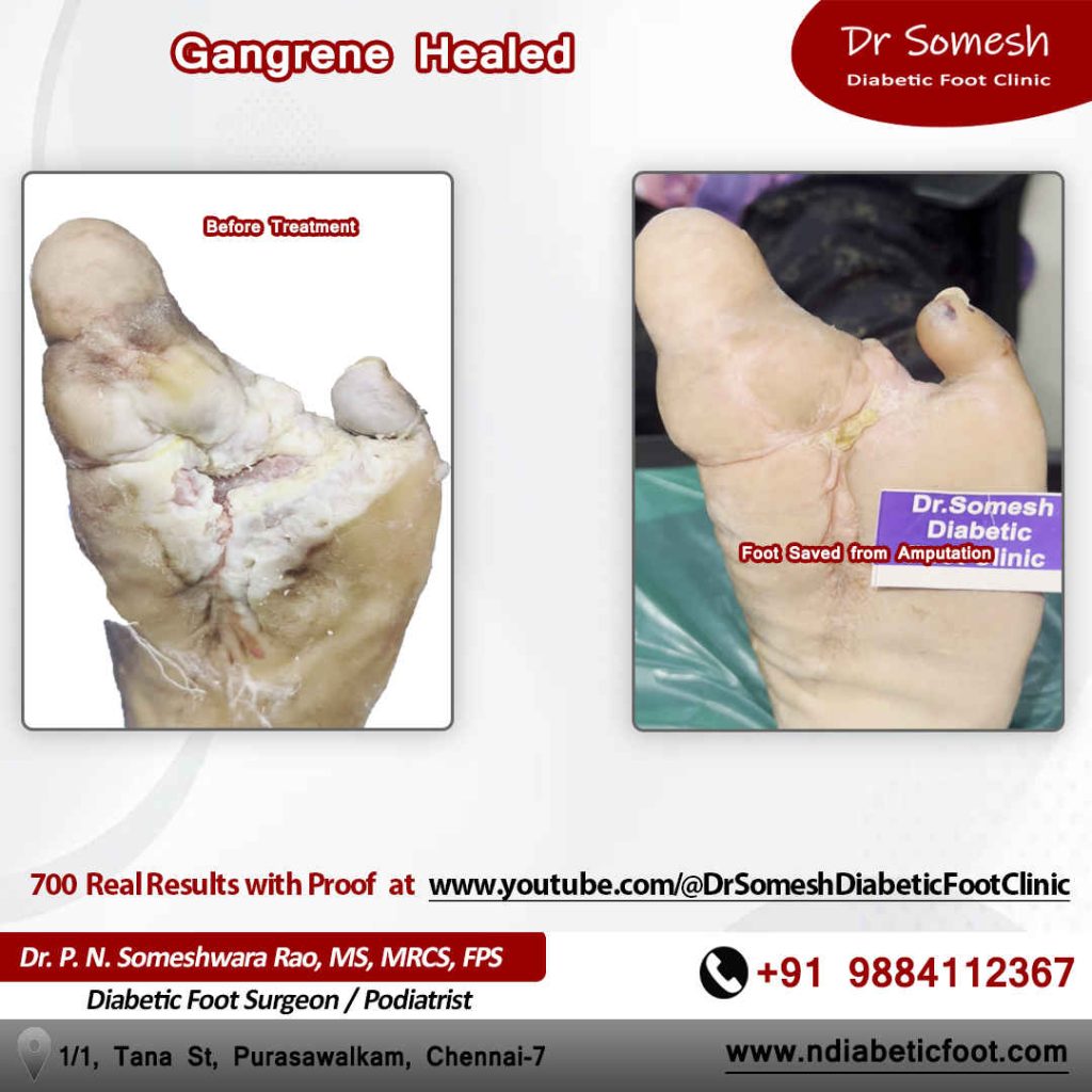 podiatrist chennai | diabetic foot clinic