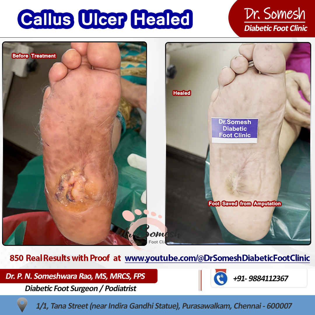 podiatrist chennai | diabetic foot clinic