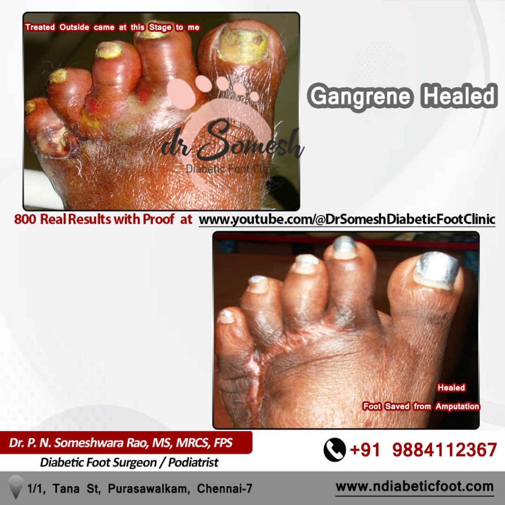 Podiatrsit Chennai | Diabetic Foot Clinic