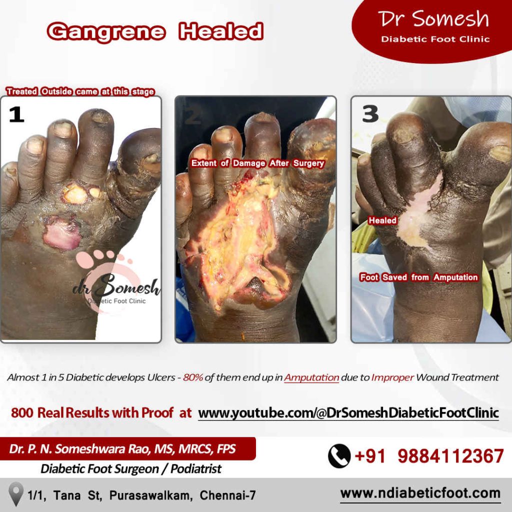 podiatrist chennai | diabetic foot clinic