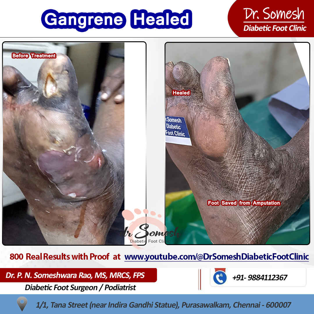 podiatrist chennai | diabetic foot clinic
