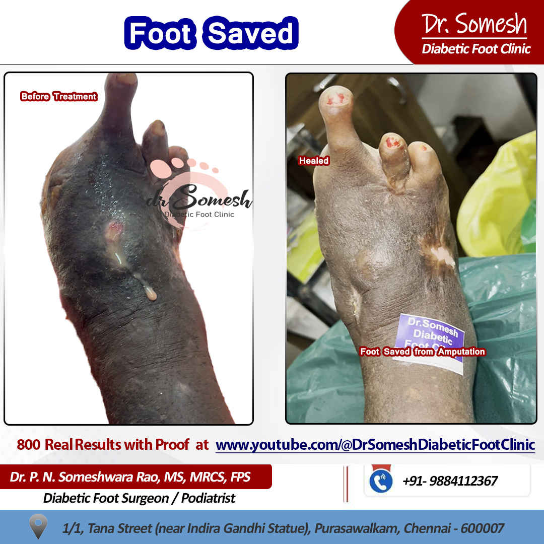 podiatrist chennai | diabetic foot clinic