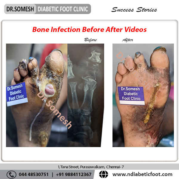 podiatrist chennai | diabetic foot clinic