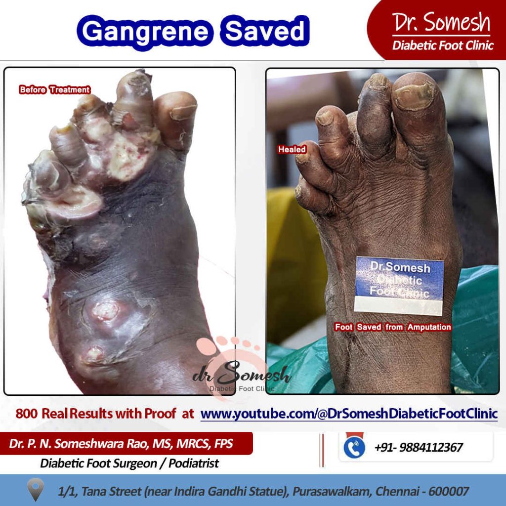 DrSomesh DiabeticFootCare | Podiatrist chennai