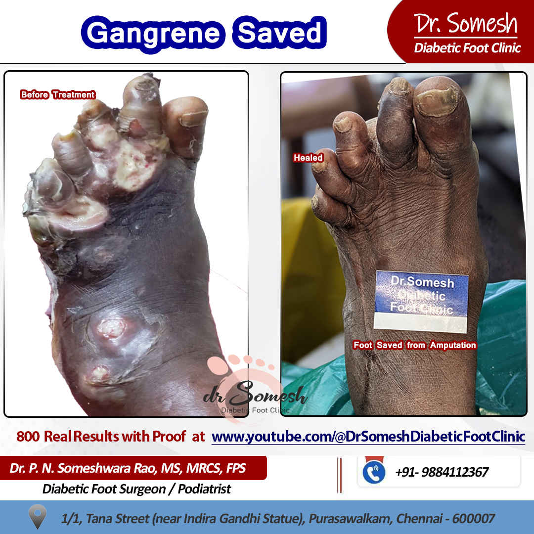 podiatrist chennai | diabetic foot clinic