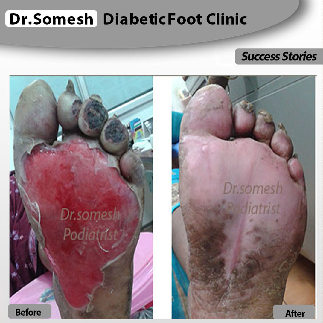 podiatrist chennai | diabetic foot clinic