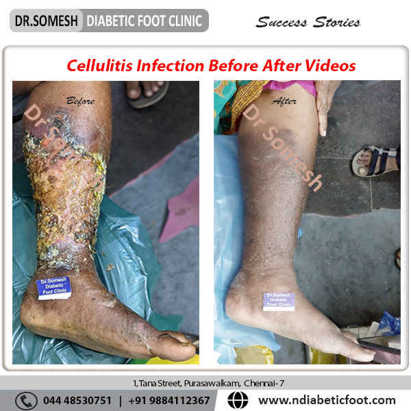 podiatrist chennai | diabetic foot clinic
