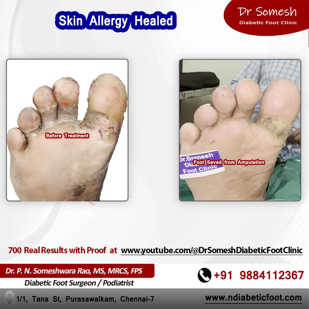 podiatrist chennai | diabetic foot clinic