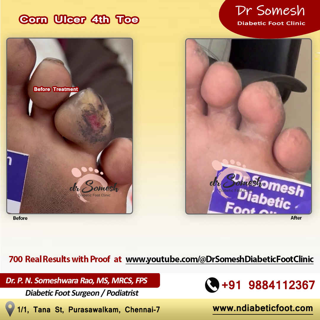 podiatrist chennai | diabetic foot clinic