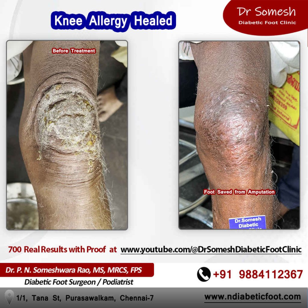 podiatrist chennai | diabetic foot clinic