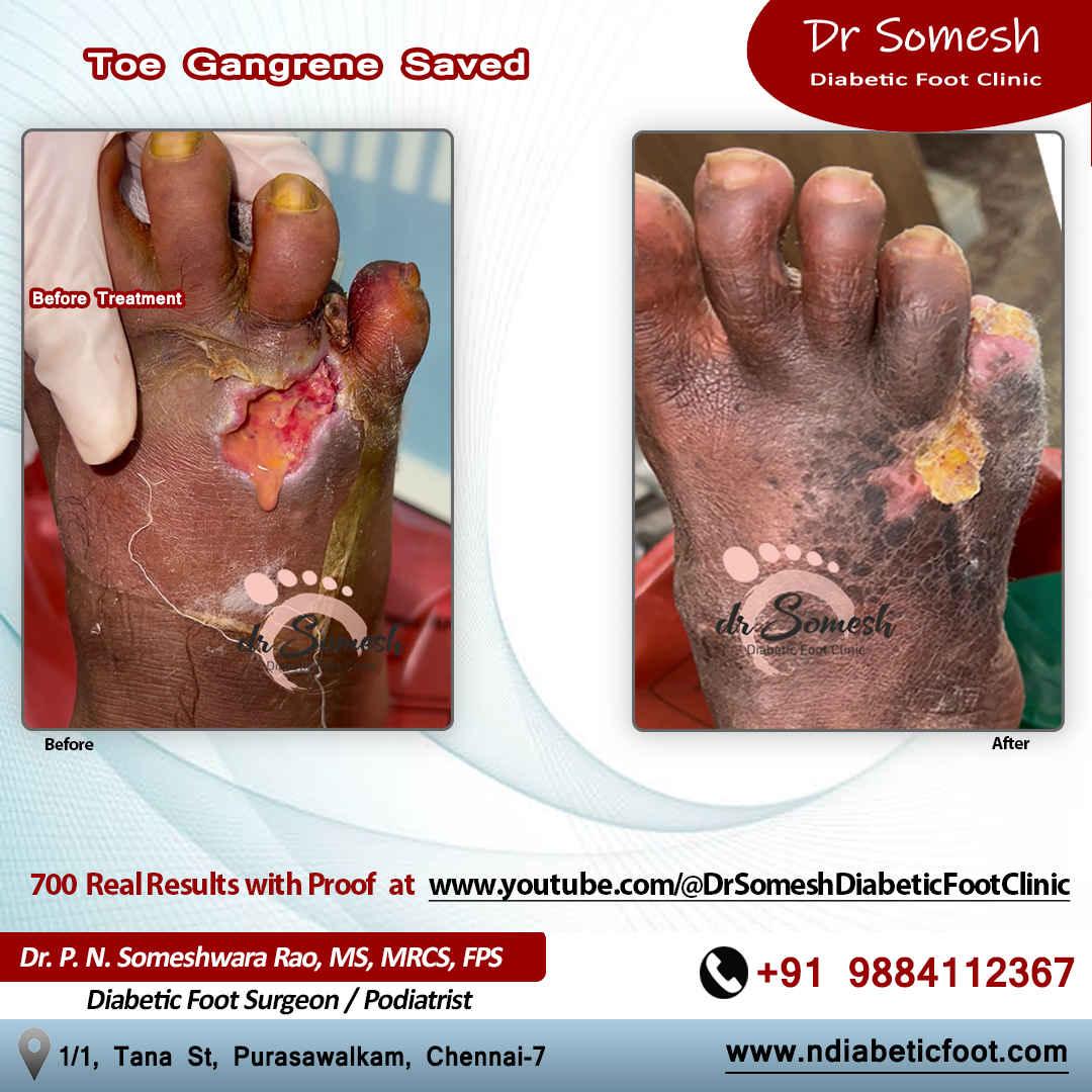 podiatrist chennai | diabetic foot clinic