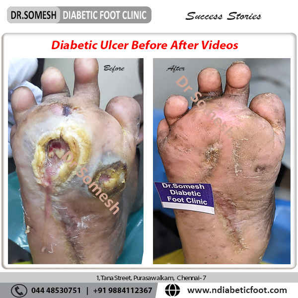 podiatrist chennai | diabetic foot clinic