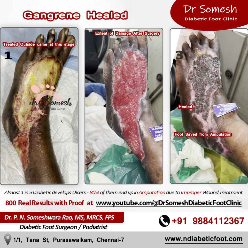podiatrist chennai | diabetic foot clinic