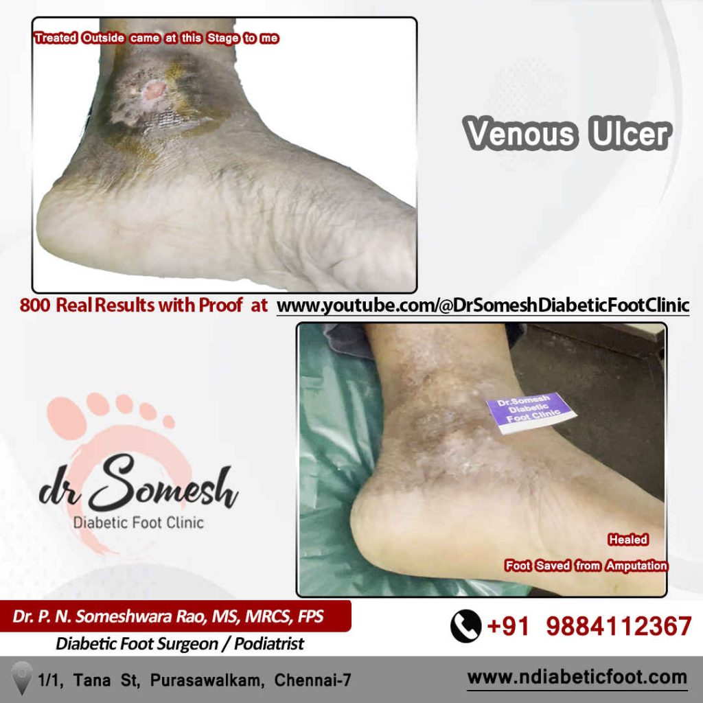 podiatrist chennai | diabetic foot clinic