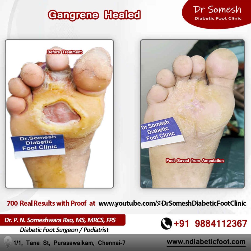 podiatrist chennai | diabetic foot clinic