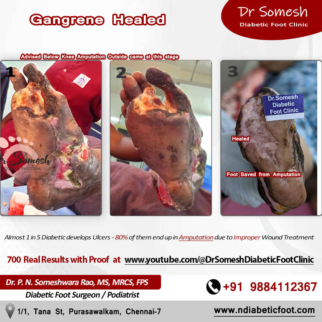 podiatrist chennai | diabetic foot clinic