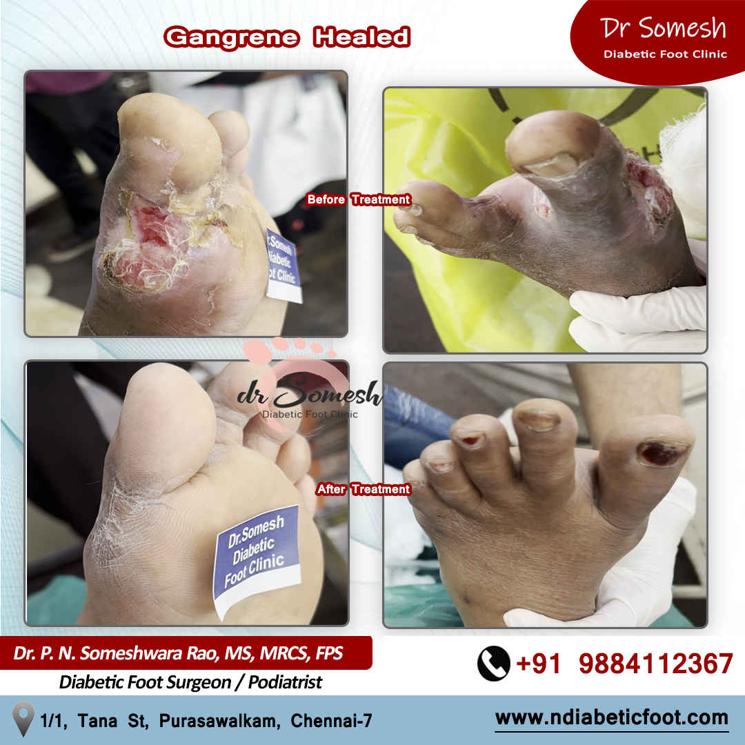 podiatrist chennai | diabetic foot clinic