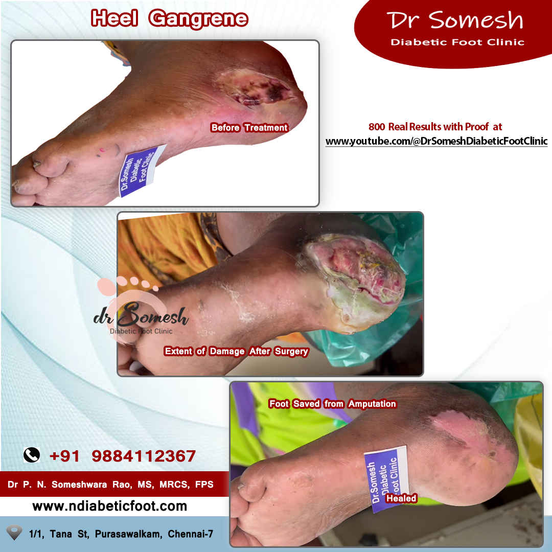 podiatrist chennai | diabetic foot clinic