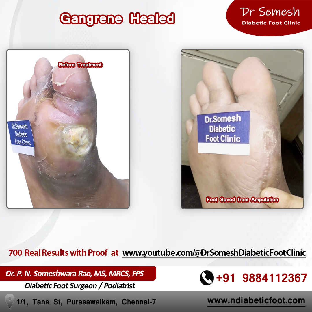 podiatrist chennai | diabetic foot clinic