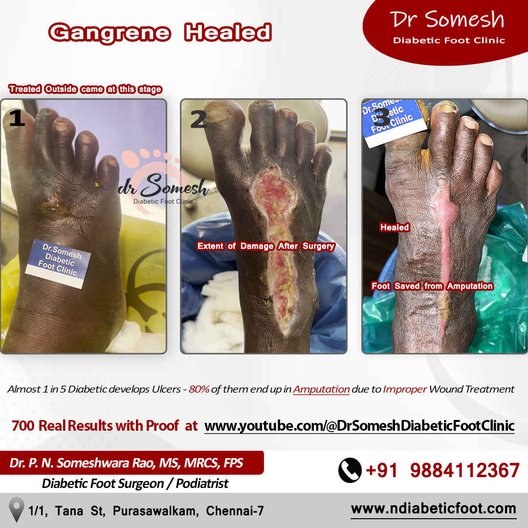 podiatrist chennai | diabetic foot clinic