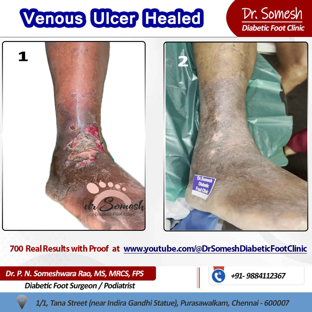 podiatrist chennai | diabetic foot clinic