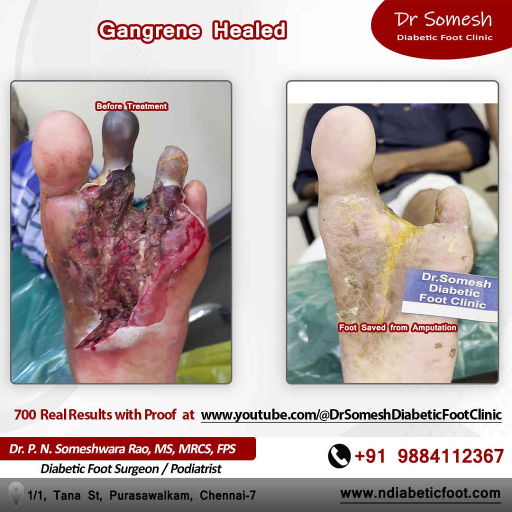 podiatrist chennai | diabetic foot clinic