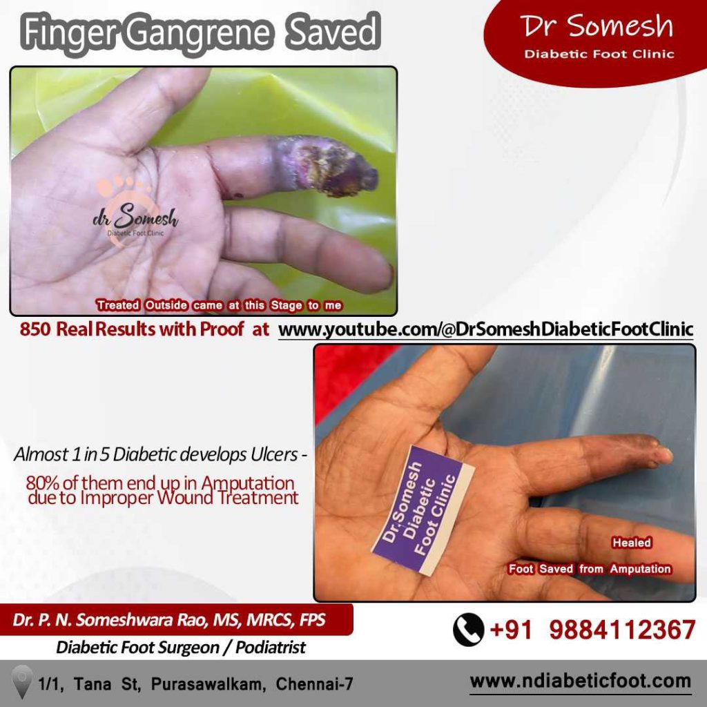 podiatrist chennai | finger infection