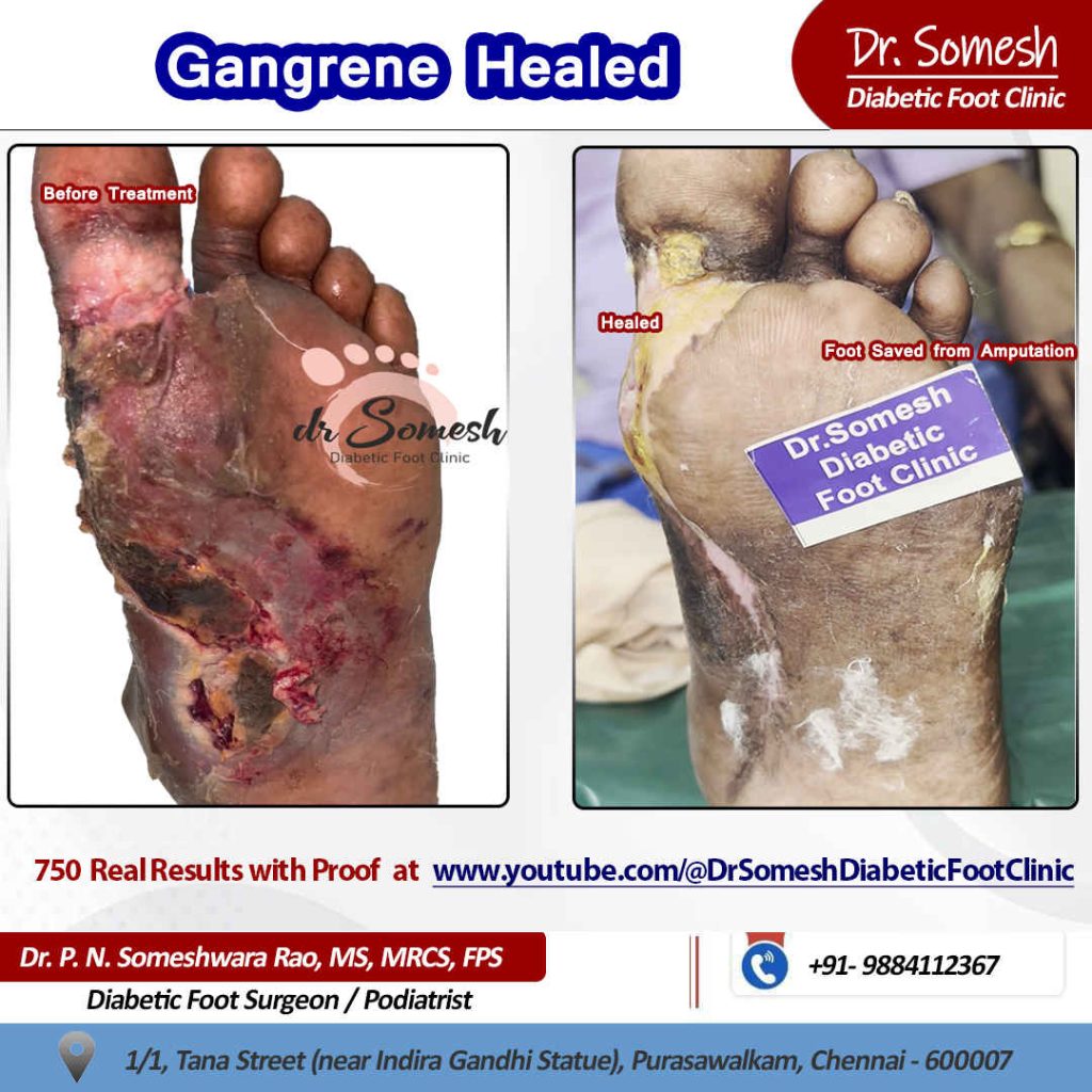 podiatrist chennai | diabetic foot clinic
