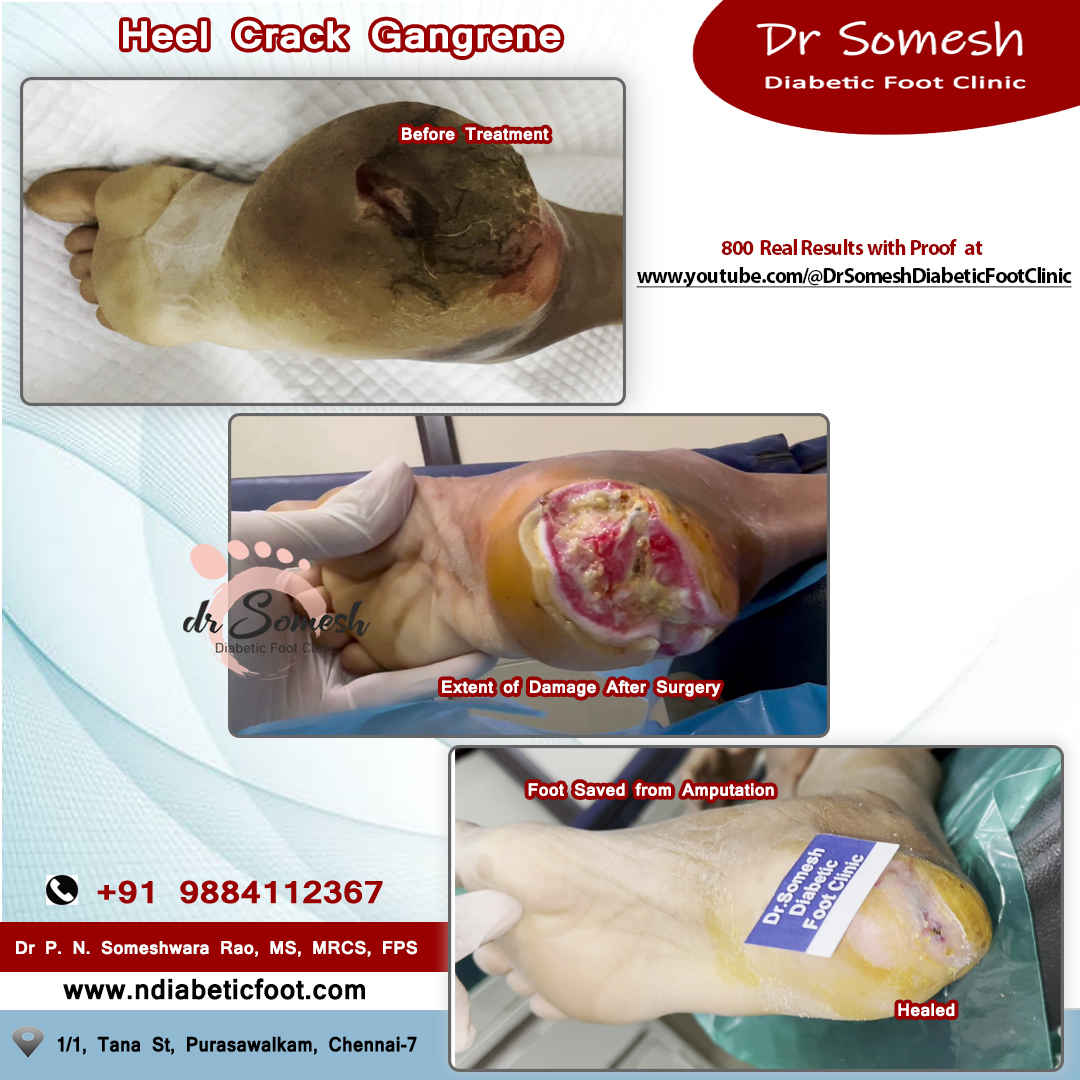 podiatrist chennai | diabetic foot clinic
