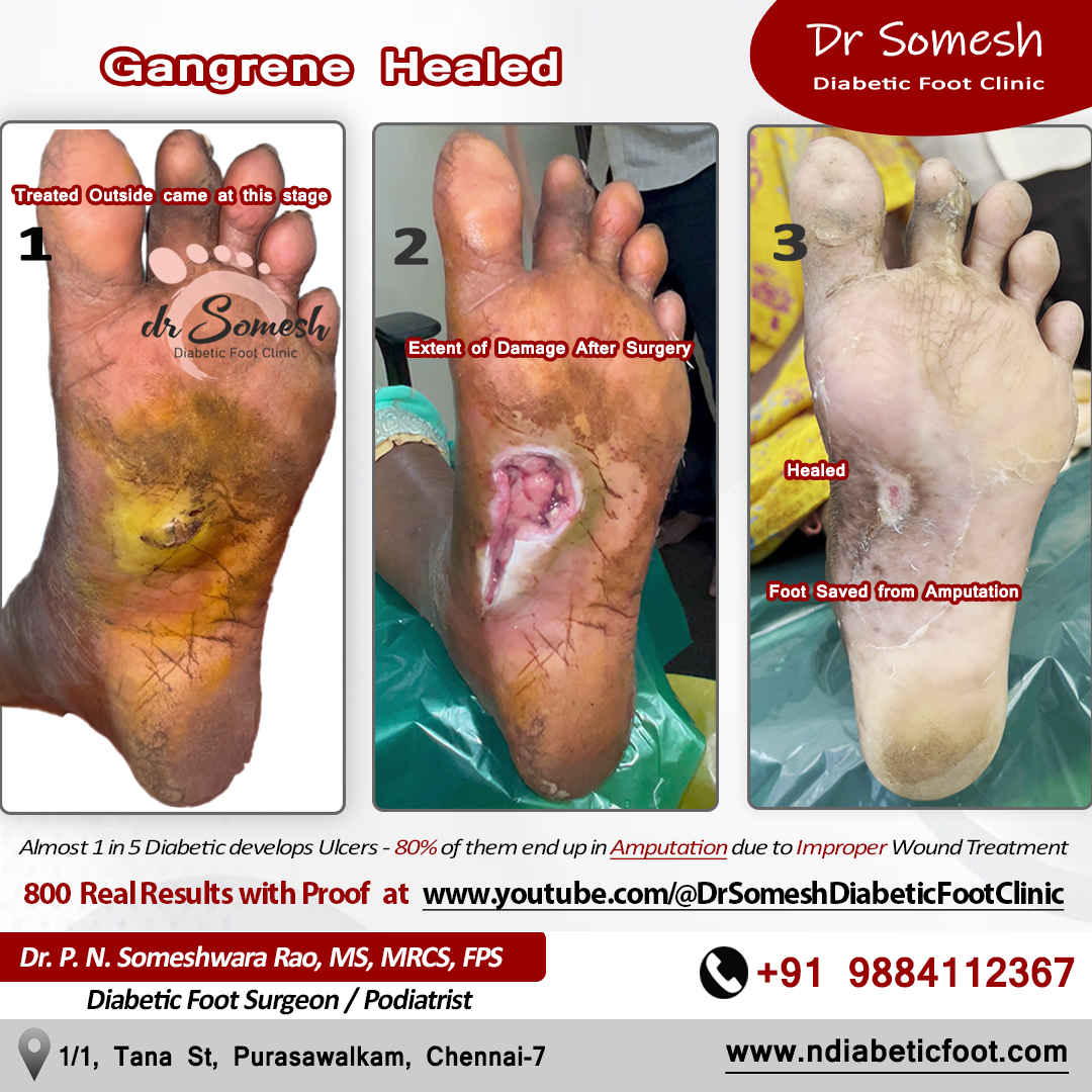 podiatrist chennai | diabetic foot clinic