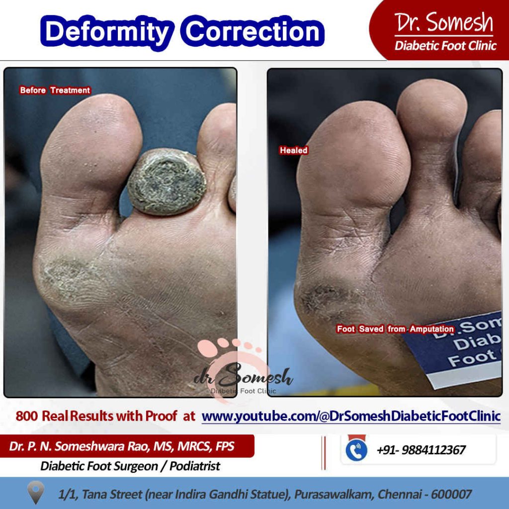 podiatrist chennai | diabetic foot clinic