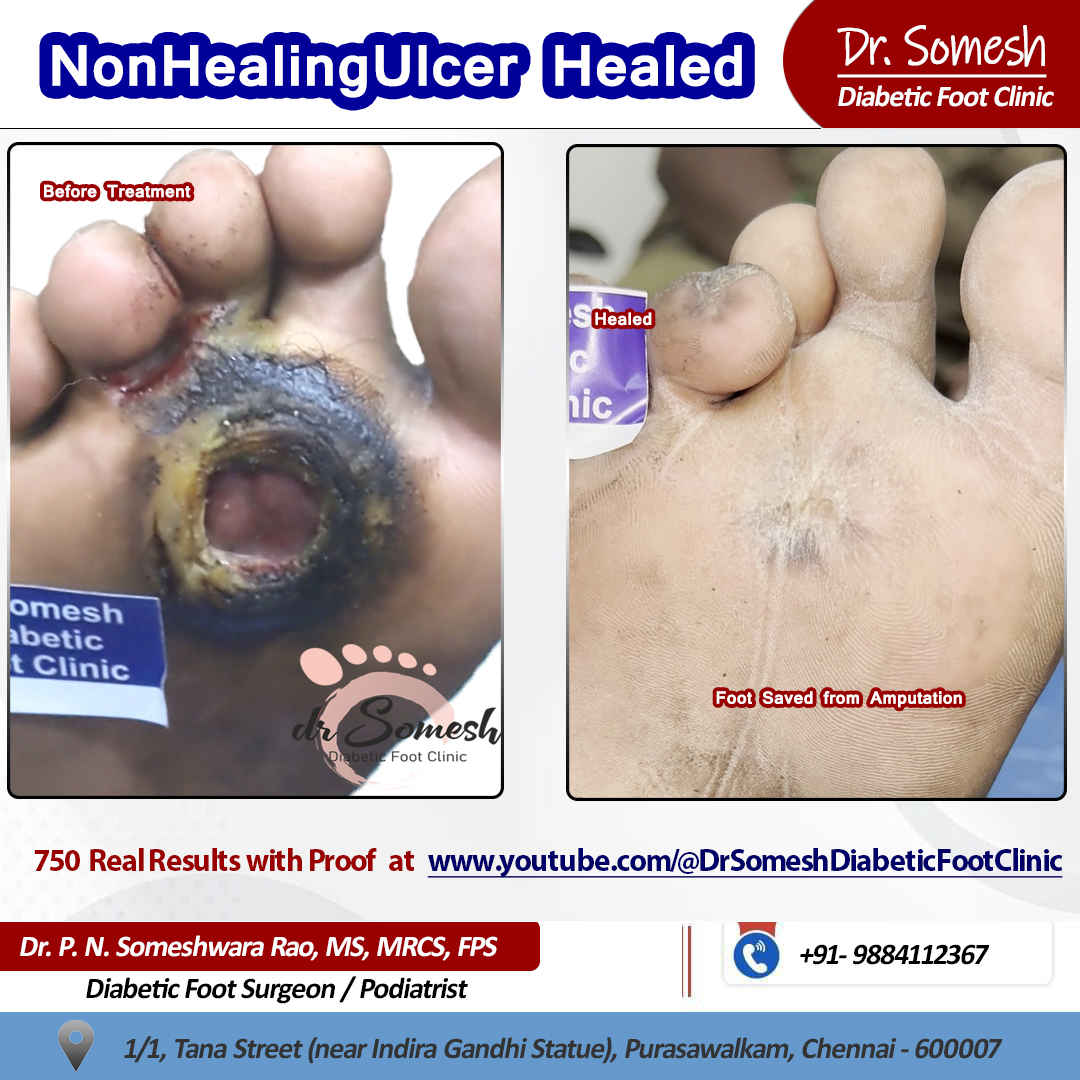Podiatrsit Chennai | Diabetic Foot Clinic