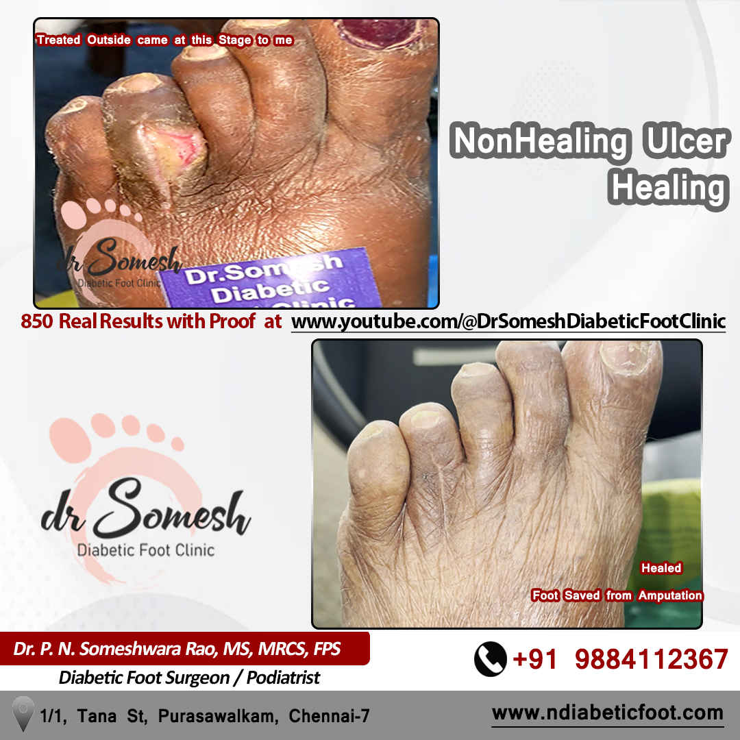 podiatrist chennai | diabetic foot clinic