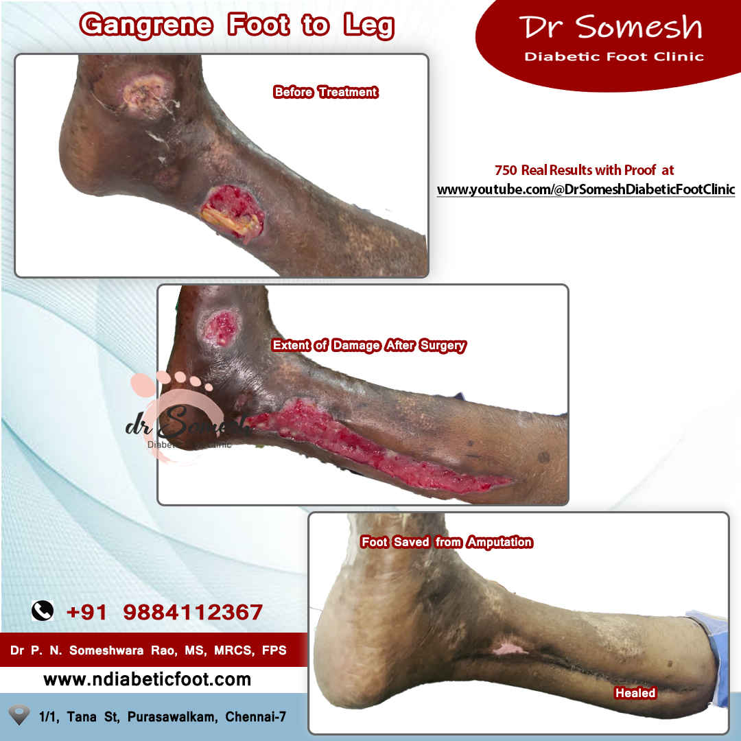 podiatrist chennai | diabetic foot clinic