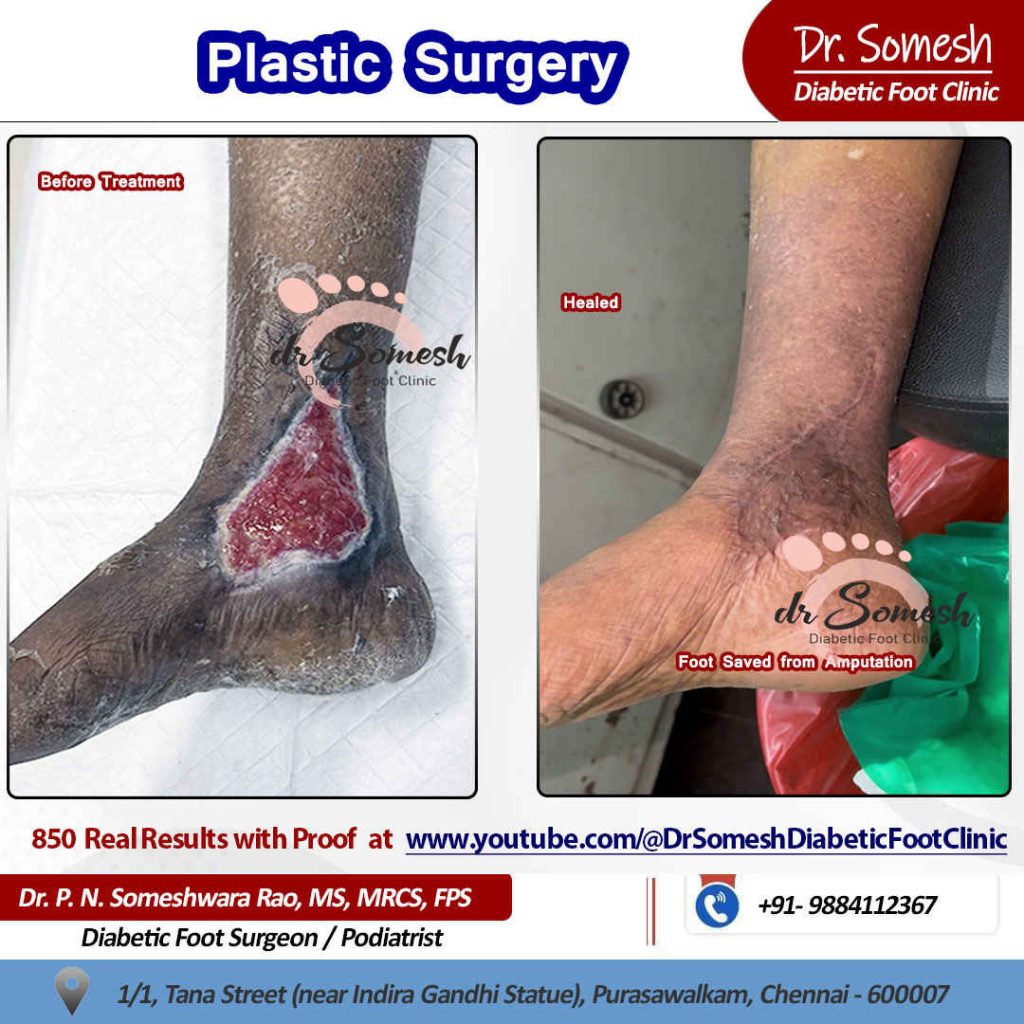 podiatrist chennai | diabetic foot ulcer
