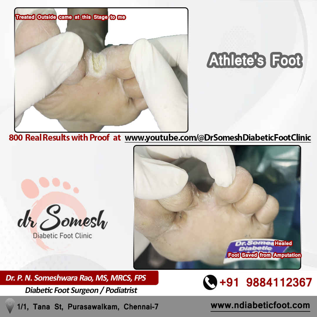 podiatrist chennai | diabetic foot clinic