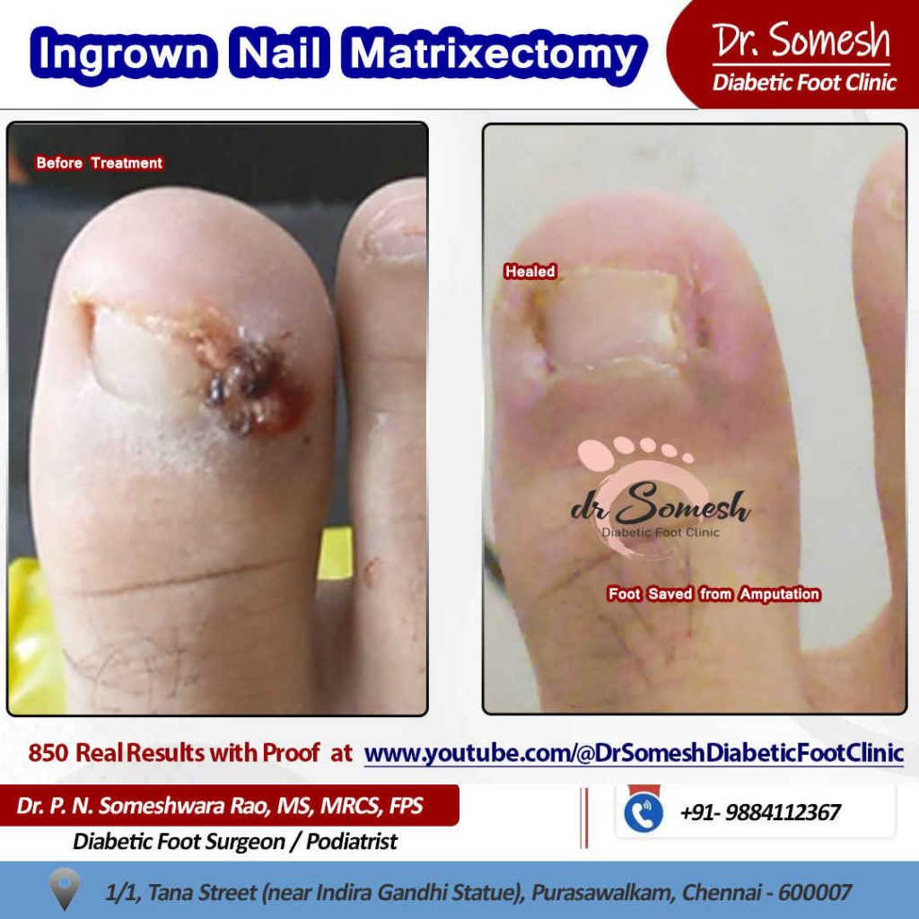 Podiatrsit Chennai | Diabetic Foot Clinic