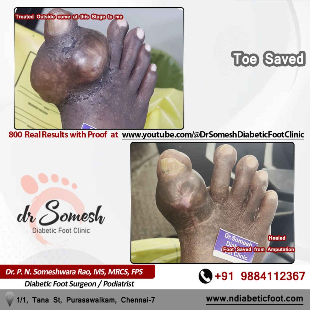 podiatrist chennai | diabetic foot clinic