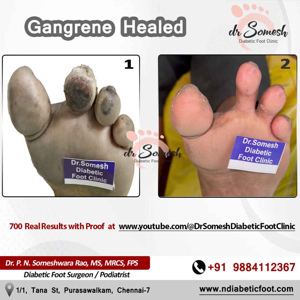 podiatrist chennai | diabetic foot clinic