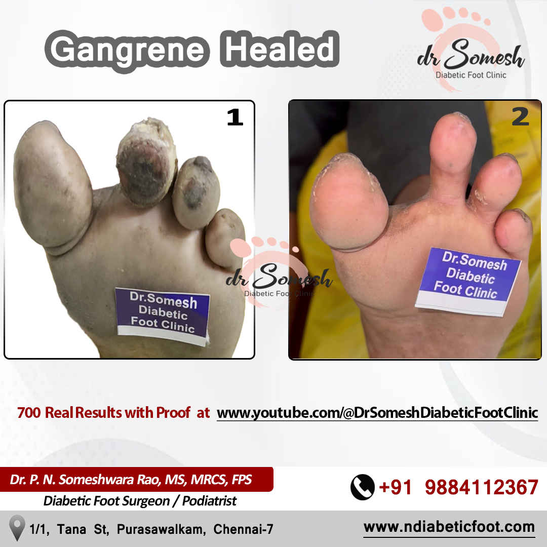 podiatrist chennai | diabetic foot clinic
