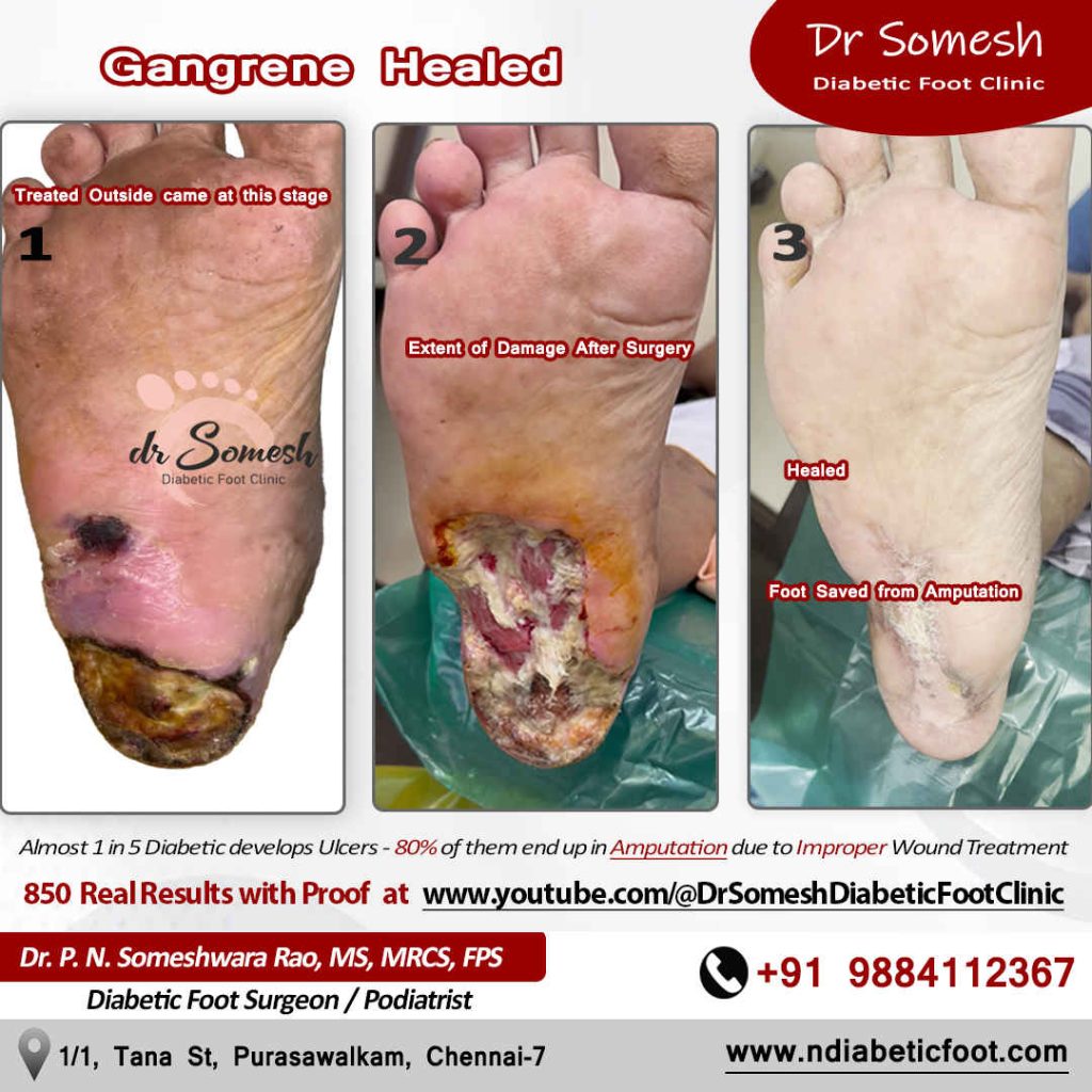 podiatrist chennai | diabetic foot clinic