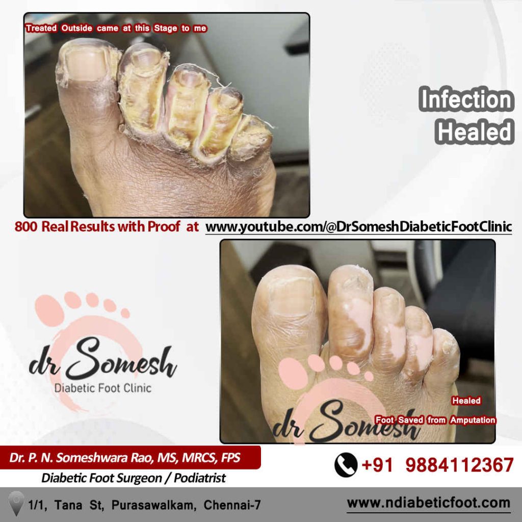 podiatrist chennai | diabetic foot clinic