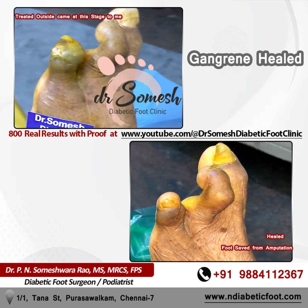 podiatrist chennai | diabetic foot clinic