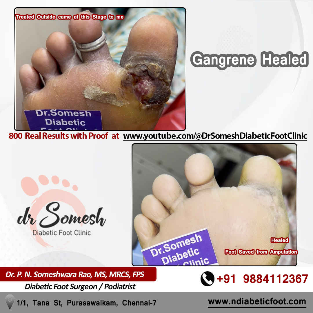 podiatrist chennai | diabetic foot clinic