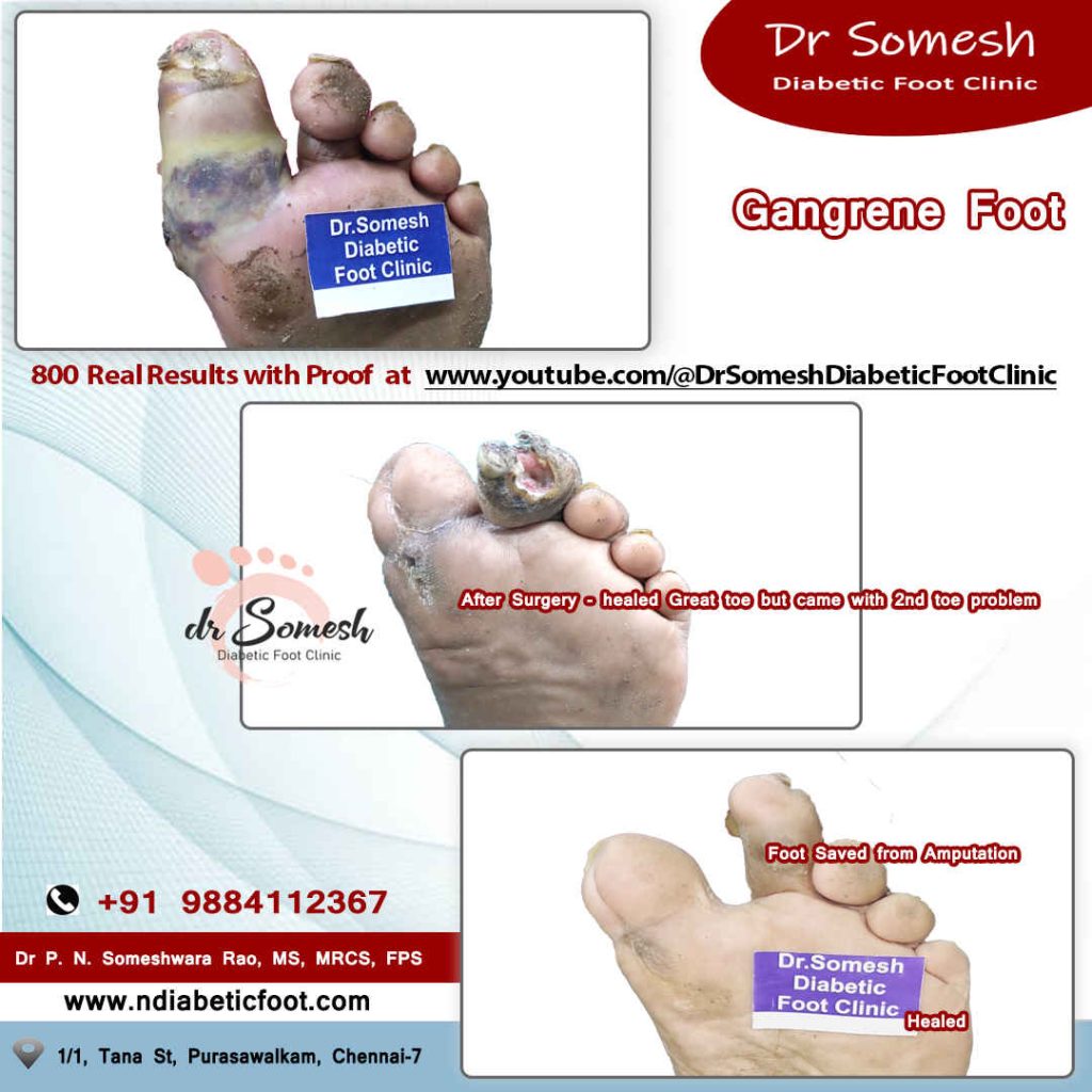 podiatrist chennai | diabetic foot clinic