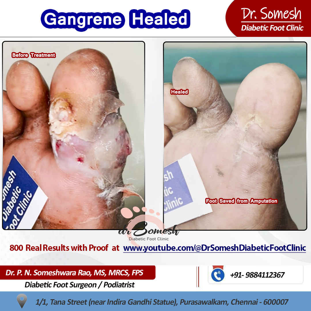 podiatrist chennai | diabetic foot clinic