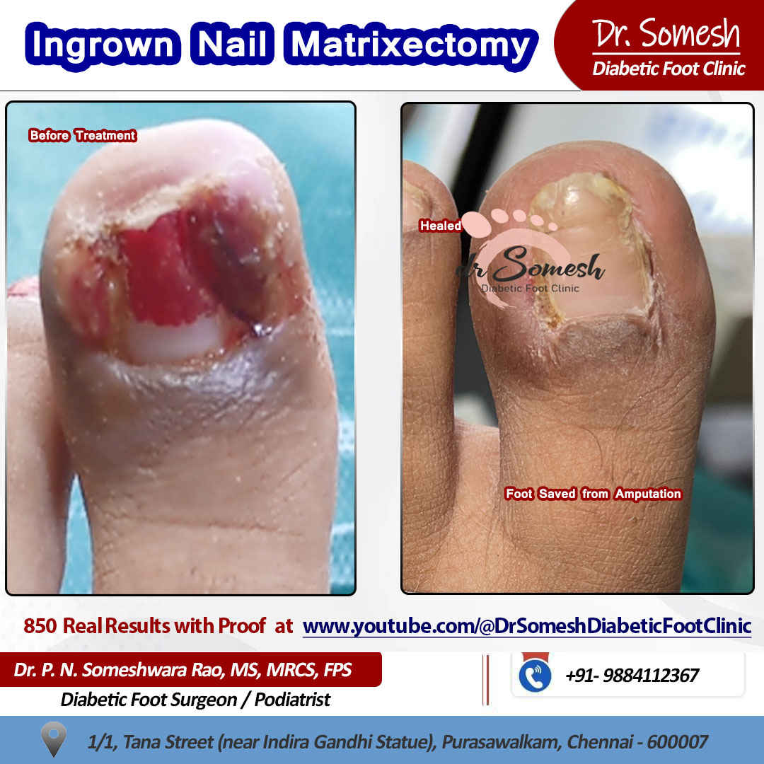 Podiatrsit Chennai | Diabetic Foot Clinic