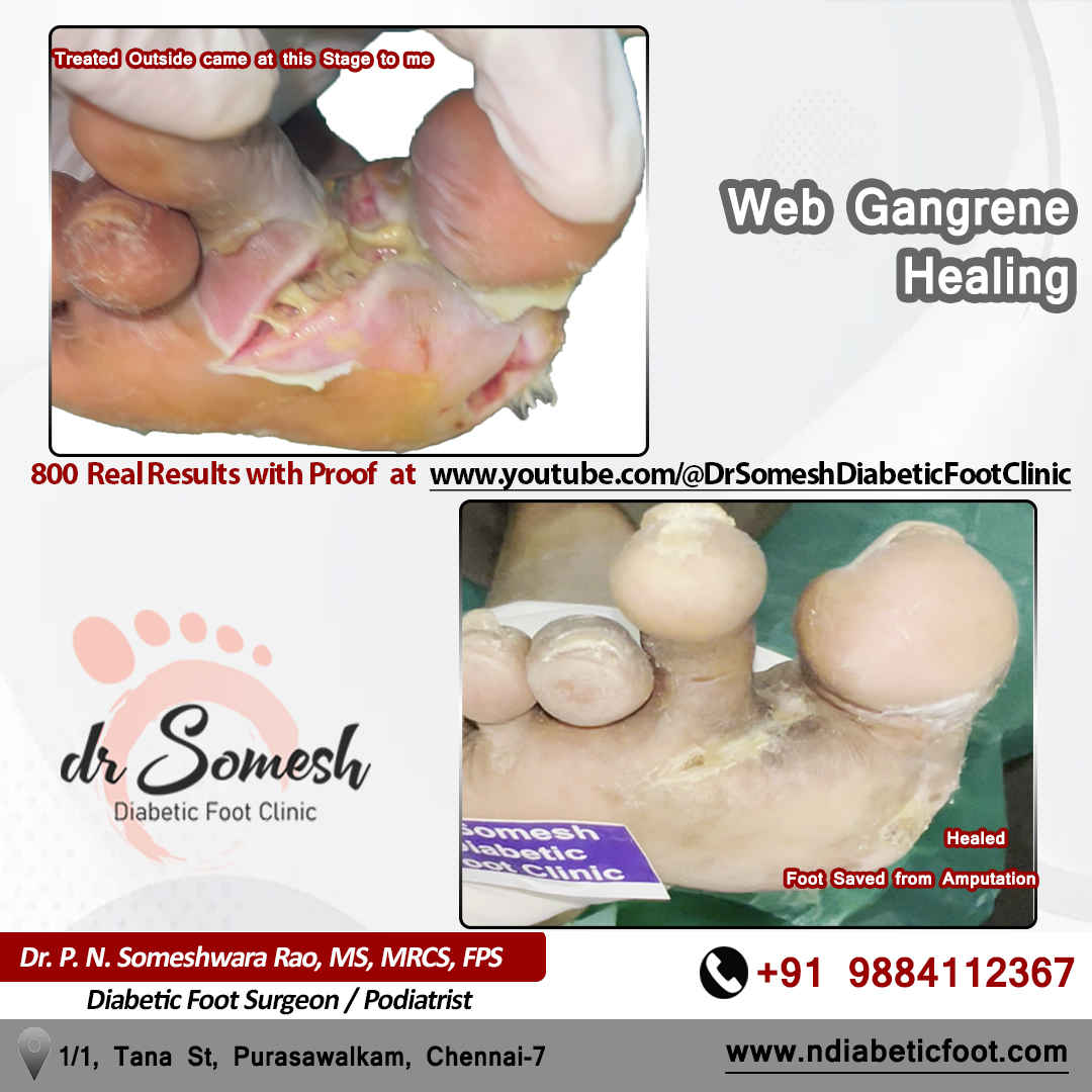 podiatrist chennai | diabetic foot clinic