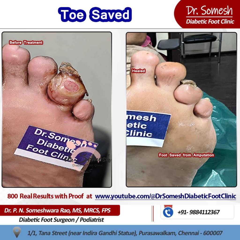 podiatrist chennai | diabetic foot clinic