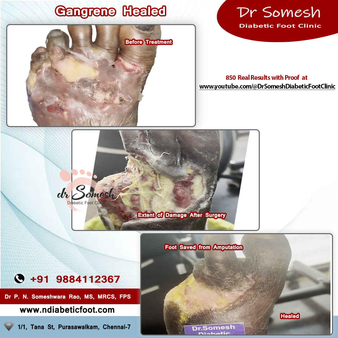 podiatrist chennai | diabetic foot clinic